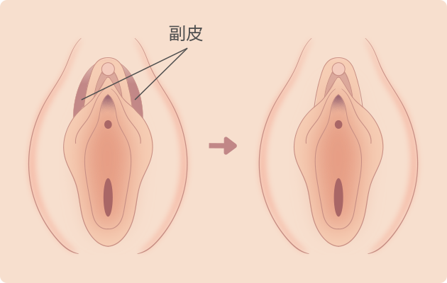 副皮除去・切除